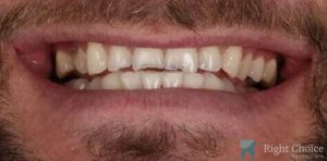 Smile Makeover-08 Before