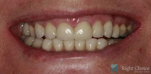 Smile Makeover-09 After