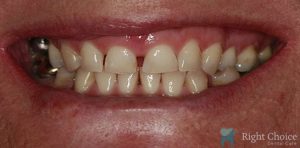 Smile Makeover-09 Before
