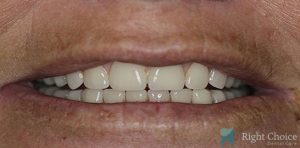 Smile Makeover-10 After