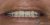 Smile Makeover-10 After