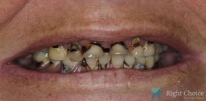 Smile Makeover-10 Before