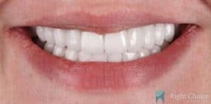 Smile Makeover-11 Before