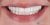 Smile Makeover-11 Before