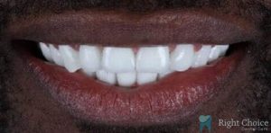 Smile Makeover-12 After