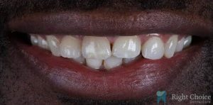Smile Makeover-12 Before