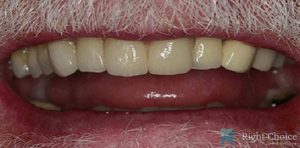 Smile Makeover-13 After