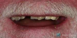 Smile Makeover-13 Before