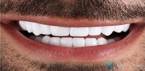 Smile Makeover-14 After