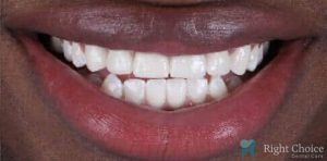 Smile Makeover-15 After