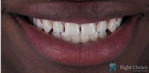 Smile Makeover-15 Before