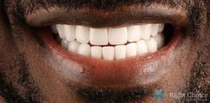 Smile Makeover-16 After