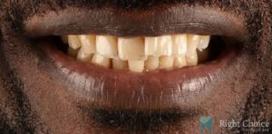 Smile Makeover-16 Before