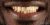 Smile Makeover-16 Before