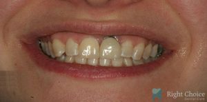 Implants-11 Before