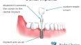 What is Dental Implants?