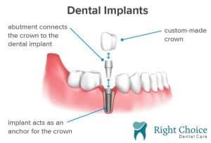 Dental implants provide a permanent solution for missing teeth