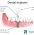 What is Dental Implants?